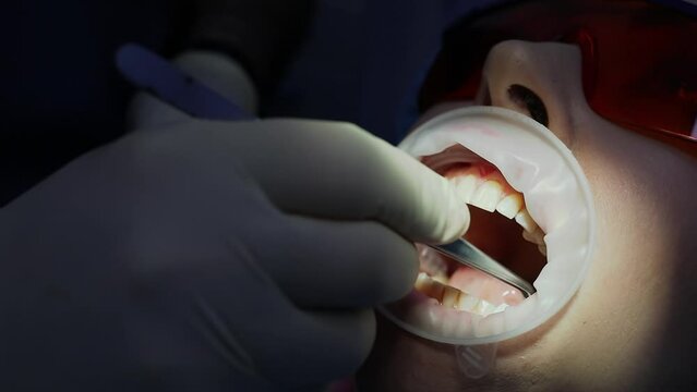 Dentist uses pincers for inserts tampon in patient mouth with lips holder. Slow motion