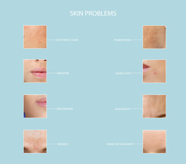 Age spots, pigmentation,rosacea, acne , acne scars,Hirsutism - obrazy, fototapety, plakaty
