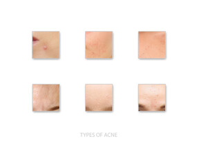 Types of Acne - obrazy, fototapety, plakaty