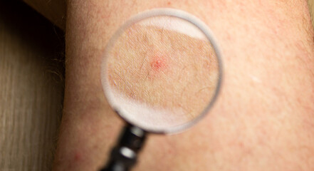 Pimple, red inflammation on the skin of the leg through a magnifying glass. Pimple concept