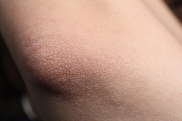 Woman with dry skin on elbow, closeup