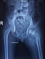 X-ray of pelvis. Chronic osteomyelitis involving proximal shaft and neck of the femur. Defused...