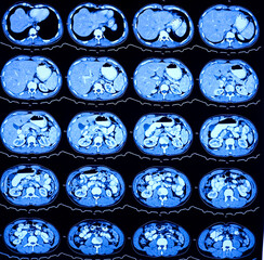 CT scan of HBS and Pancreas (Contrast): Solitary, non enhancing, hypodense lesion having ill...