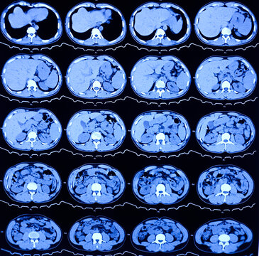 CT scan of HBS and Pancreas (Contrast): Solitary, non enhancing, hypodense lesion having ill defined margin noted. Atypical hemangioma or vascular malformation or mitotic lesion.