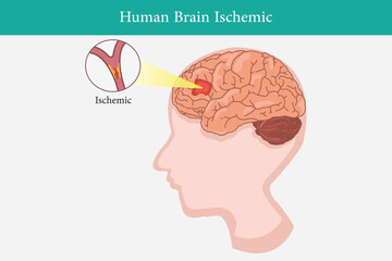 Human anatomy disease ischemic stroke vector illustration on white background. eps 10