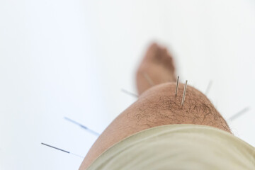 Closeup of acupuncture needles on thigh of Chinese man during acupuncture treatment