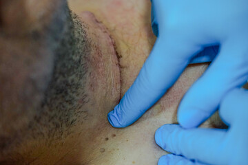 wound care, thyroid surgery, cleaning and disinfection of the operated area, observing that everything is going well