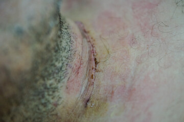 wound care, thyroid surgery, cleaning and disinfection of the operated area, observing that everything is going well