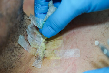 Approach points after thyroid surgery, points, removal of them and how they look when replacing new...
