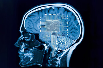 X-ray of the human brain with implanted chip, futuristic concept, generative ai