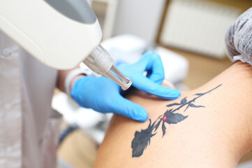 cosmetologist removes the tattoo to the patient using a neodymium laser in a modern clinic....