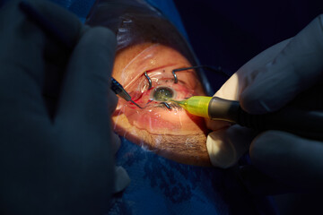 Phacoemulsification, destruction of the opaque lens by ultrasound, ophthalmic eye surgery. eye lens...