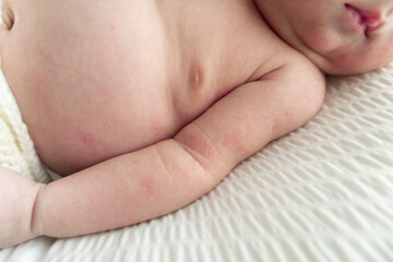 Newborn baby body with red rash.