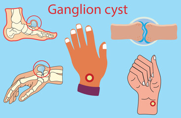 Ganglion cyst,soft, gel like masses,smooth and round,welling in the hand, wrist and foot,Medical vector illustration of ganglion foot cyst with bones. Big ganglion cysts,a sac of jelly fluid,vectors