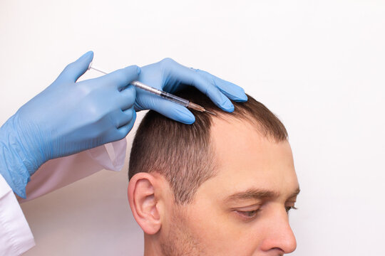 Mesotherapy procedure. A cosmetologist gives an injection with a syringe and a needle to a young man with bald patches on his forehead and head. Hair loss problem. Treatment of scalp and hair