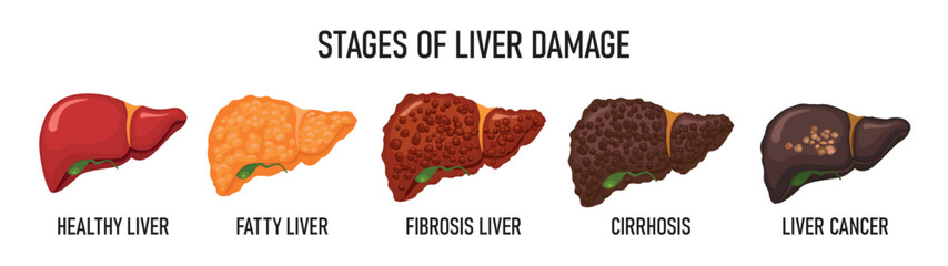 Stages of liver destruction - obrazy, fototapety, plakaty
