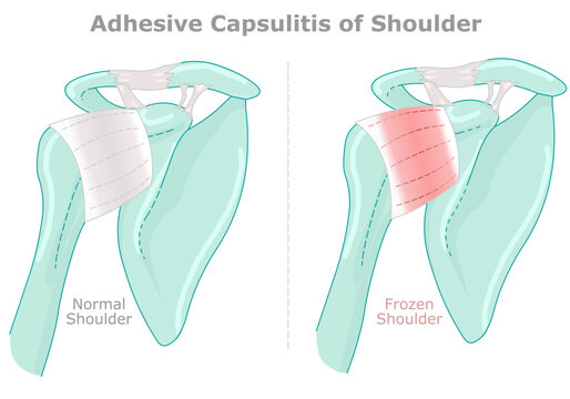 Adhesive capsulitis or frozen shoulder. Capsule and bone broken arm. Shoulder joint becomes inflamed and stiff over. Medical illustration. Vector