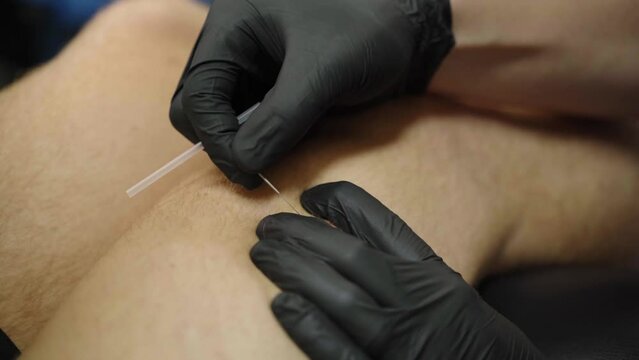 Professional Acupuncturist with black gloves penetrating the skin with metallic needle, closeup shot