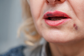 Bruises in the places of lip injections, injection into the lips of an adult woman in close-up, the introduction of fillers and lip augmentation are unsuccessful