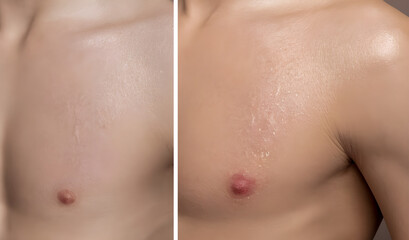 Man breast before and after cream treatment. Before and after treatment. - 732023068