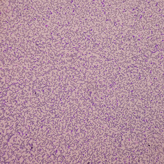 Acute myeloid leukemia (AML). Smear show shift maturation of then are blast cells, low N : C ratio,...