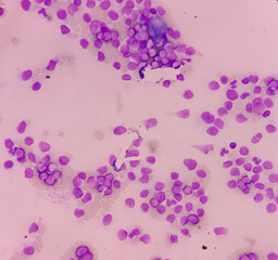 Acute myeloid leukemia (AML). Smear show shift maturation of then are blast cells, low N : C ratio, abundant cytoplasm, loose chromatin and prominent nucleoli. Thrombocytopenia.