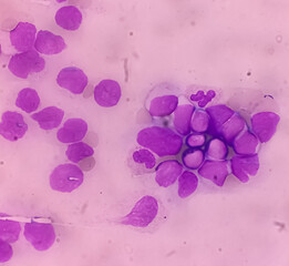 Acute myeloid leukemia (AML). Smear show shift maturation of then are blast cells, low N : C ratio,...