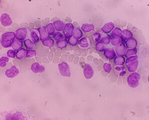 Acute myeloid leukemia (AML). Smear show shift maturation of then are blast cells, low N : C ratio,...