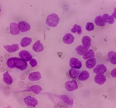 Acute myeloid leukemia (AML). Smear show shift maturation of then are blast cells, low N : C ratio, abundant cytoplasm, loose chromatin and prominent nucleoli. Thrombocytopenia.
