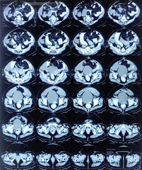 Metastatic adenocarcinoma patient. CT scan of whole abdumen. Acalculus cholecystitis....