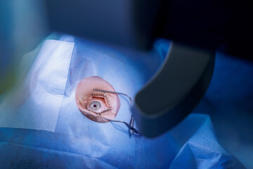 Process laser vision correction, lasik treatment. Doctor use equipment for fixing eyeball, patient...
