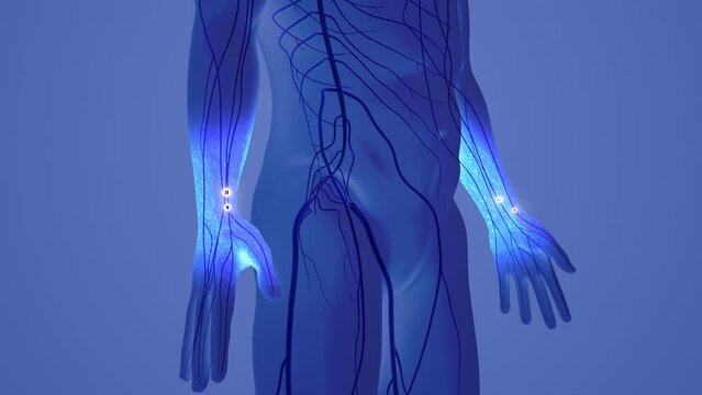  Hand numbness and Tingling Carpal Tunnel