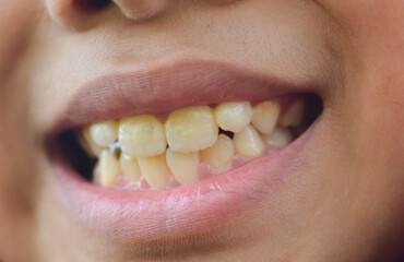 a child displaying his yellowed teeth, highlighting the importance of dental health care and hygiene practices in dentistry.