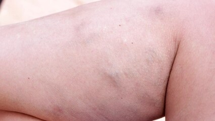 varicose veins, deep vein thrombosis, venous injuries on legs