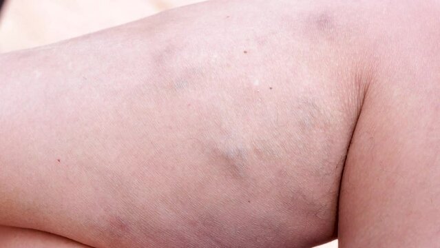 varicose veins, deep vein thrombosis, venous injuries on legs