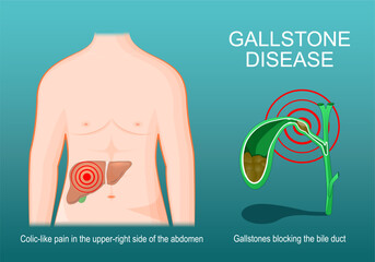 Cross section of Gallbladder with Gallstones