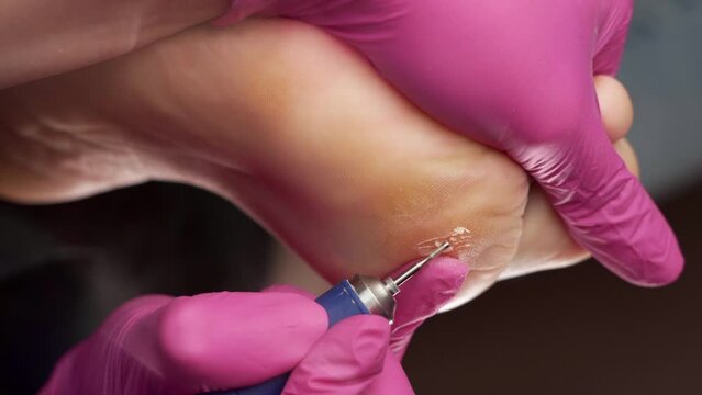 Chiropodist in pink goves does hardware peeling of the skin of the female dry foot. Close-up. Professional pedicure and podology concept.