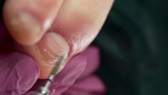 Hardware Treatment of nail fungus. Pedicure podology treatment process of onychomycosis fungal infection of the toenail.