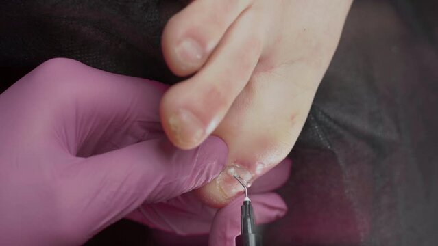 Correction of nail deformity. Toenail clip. Close-up of podologist puts a metal nail clamp on an ingrown toenail.