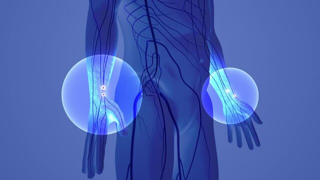 Carpal tunnel syndrome with tingling in the hands