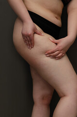 Cellulite. Stretch marks on the body. A young girl with cellulite. 