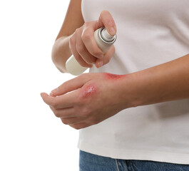 Woman applying panthenol onto burned hand on white background, closeup