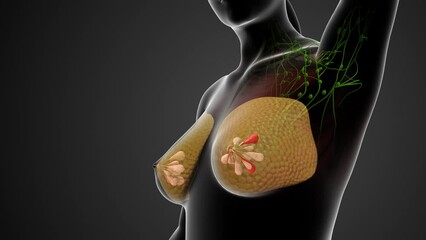 Breast cancer with medical animation