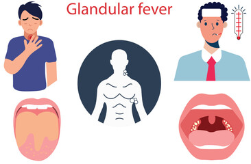 Glandular fever,high temperature (fever),sore throat , swollen glands in neck and under armpits,A swollen tongue with white coating,scarlet fever,lymphoma,Lip Syphilis bacteria virus,five vectors