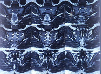 MRI (magnetic resonance imaging) of Lumbo sacral Spine. Degenerative change in lumber spine....