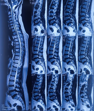 MRI (magnetic resonance imaging) of Lumbo sacral Spine. Degenerative change in lumber spine. Osteophytic change.