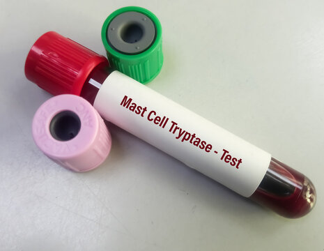 Blood Sample For Mast Cell Tryptase Test. A Tryptase Test Can Help Doctors Determine If A Severe Allergic Reaction (ANAPHYLAXIS) Has Occurred.