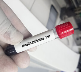 Blood tests sample for Myositis Antibody panel for the diagnosis of myositis diseases, such as...