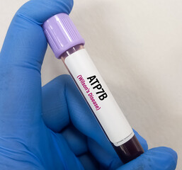 Blood sample for ATP7B(Wilson Disease) test, rare or orphan disease, Molecular Genetics test.