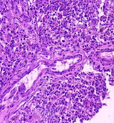 Non-Hodgkin lymphoma(Trephine biopsy tissue). Microscopically show hypercellular cell,...